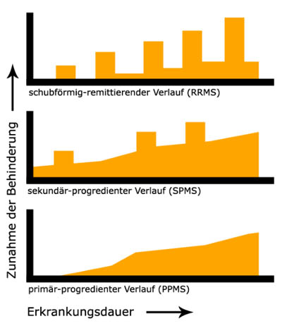 Verlaufsformen der Multiplen Sklerose